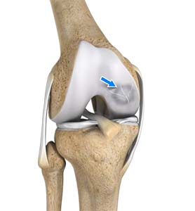 osteochondritis dissecans of the knee)